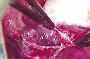 Method of Tubal Ligation Reversal: dissection to find the blockage #10