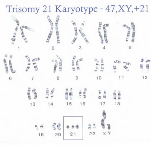 Trisomy 21 Karyotype chart - 47, XY, +21