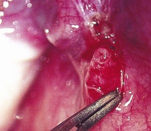 tubal ligation reversal microsurgery illustration #12