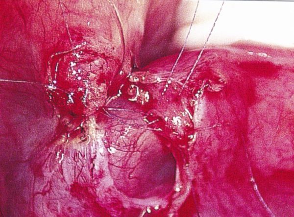 tubal ligation reversal microsurgery illustration #13