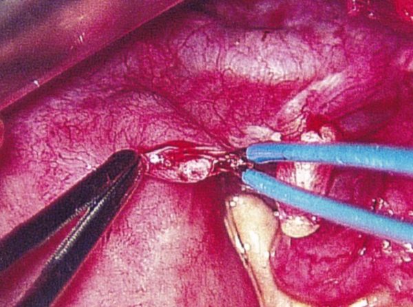 Method of Tubal Ligation Reversal: Below with micro scissors creating the opening of distal tube. #3