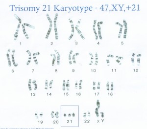 Trisomy 21 Karyotype - 47, XY, +21 Chart
