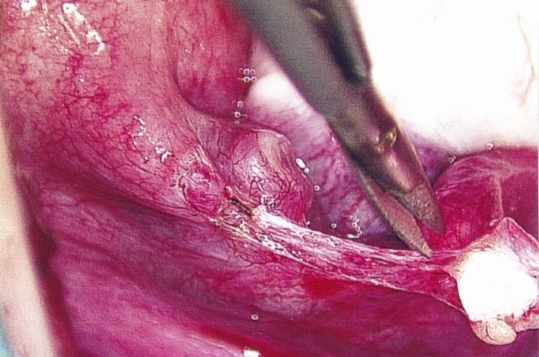 Method of Tubal Ligation Reversal: Scar tissue is dissected to expose the blocked proximal end of the distal tube. #8