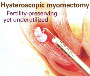General Infertility: a hysteroscopic myomectomy