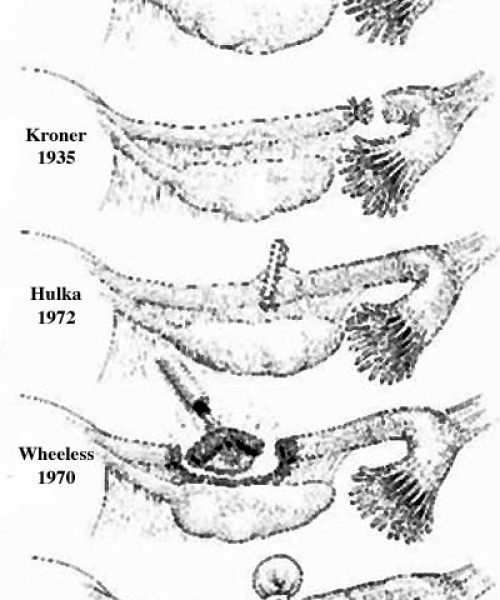 Illustration of different tubal ligation and reversal methods