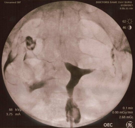 image of the hsg hysterosalpingography test